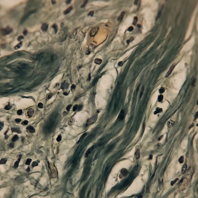 Immune cells scattered through thickened tissue under a microscope