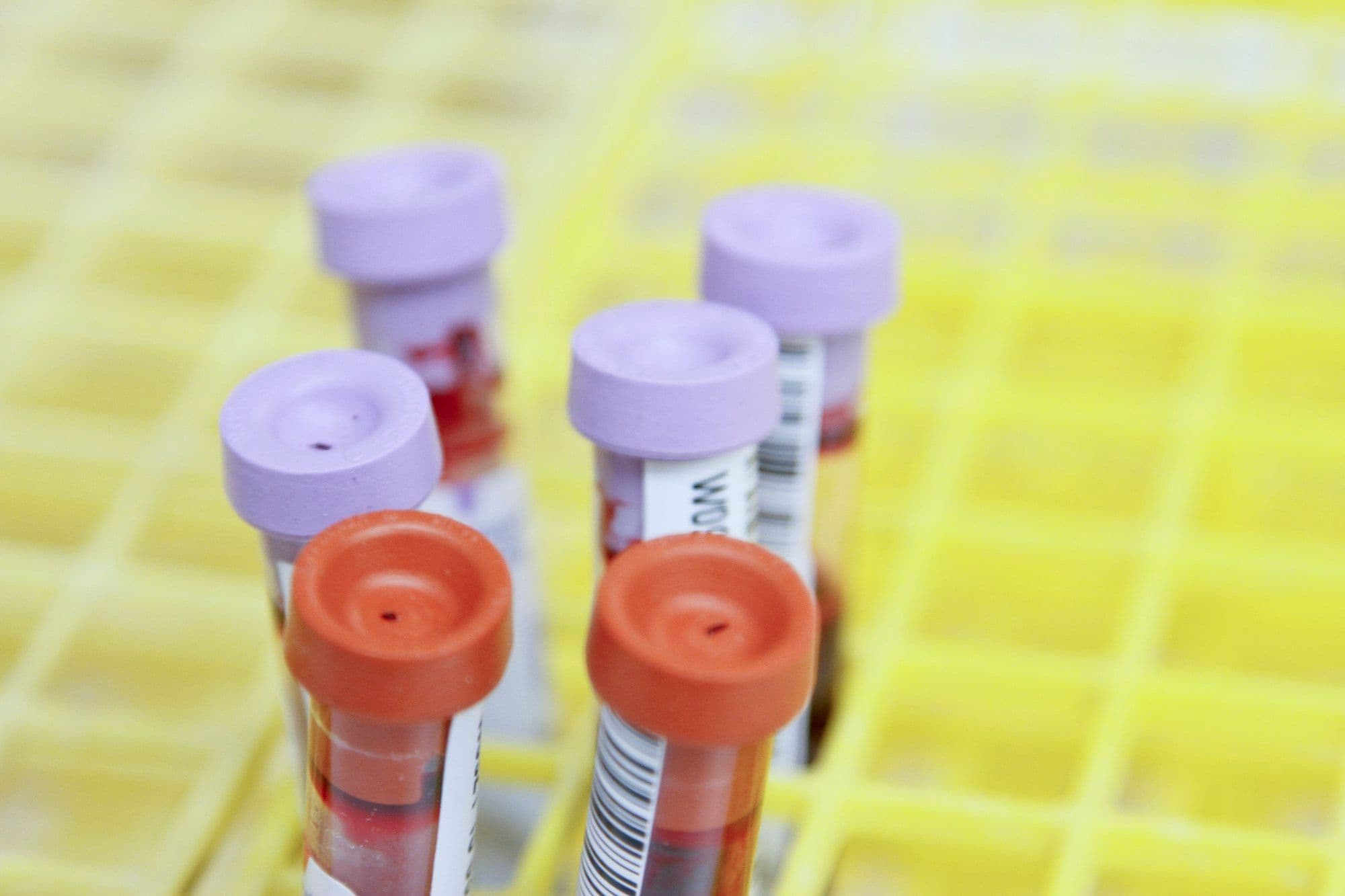 Photograph of capped blood-sample tubes in a laboratory tray